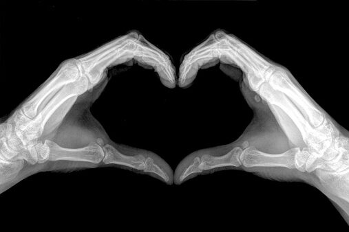 Heart sign shows by x-ray