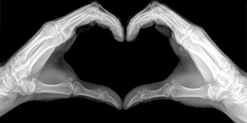 Heart sign shows by x-ray